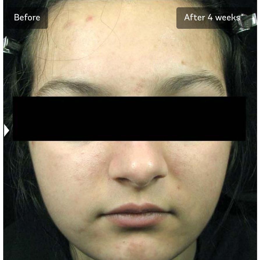 Vivier acne treatment Lotion *Special Order Product