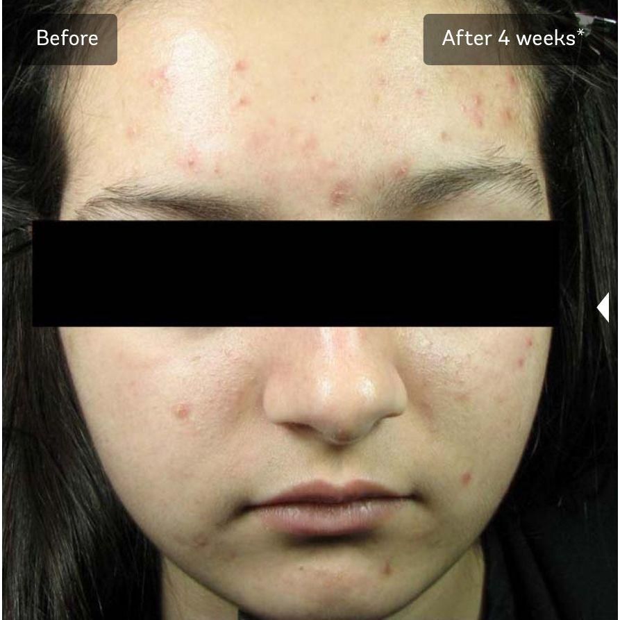 Vivier acne treatment Lotion *Special Order Product